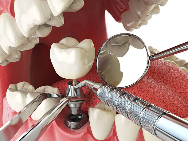 Best Lost Filling or Crown Replacement in Planada, CA
